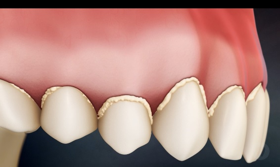 perbedaan plak gigi dan karang gigi